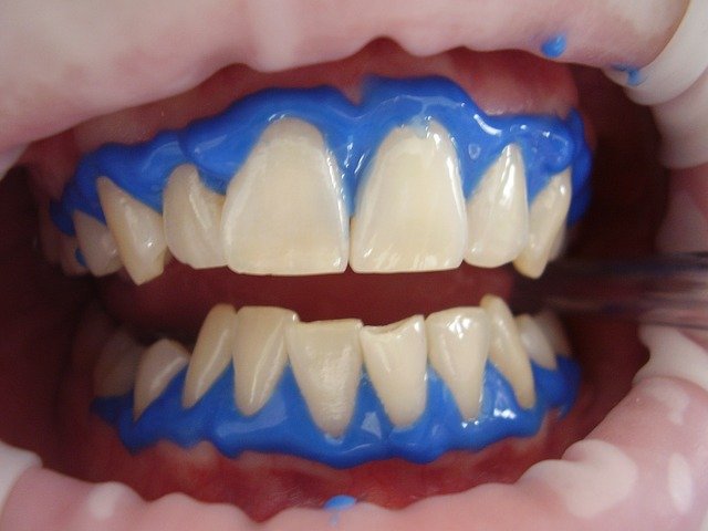 laserové bělení zubů